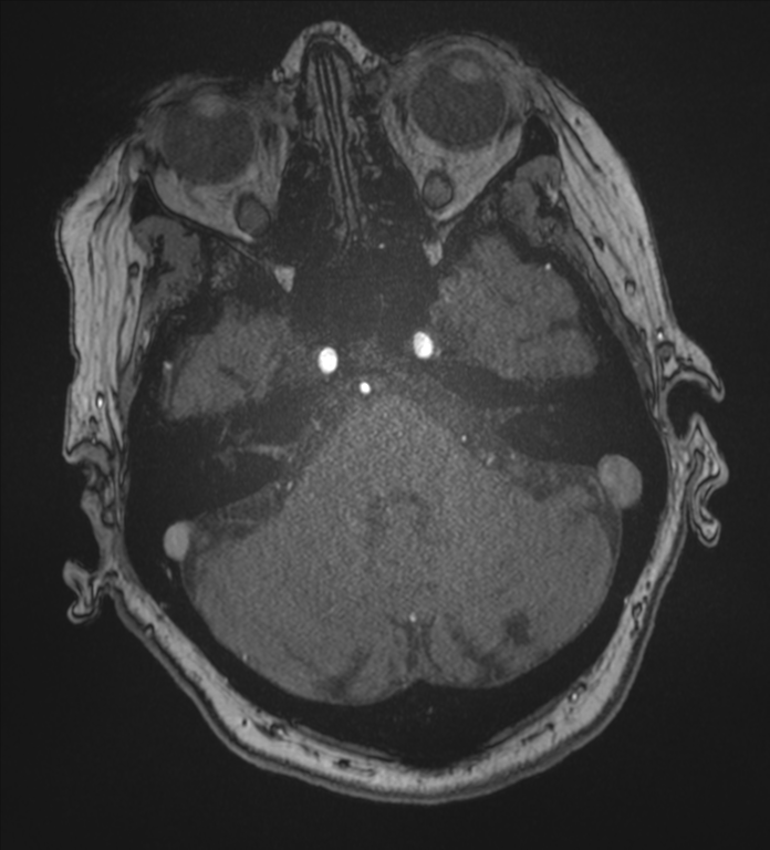 Bilateral fetal posterior communicating arteries (Radiopaedia 41286-44102 Axial MRA 43).png