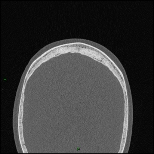 Bilateral frontal mucoceles (Radiopaedia 82352-96454 Axial bone window 33).jpg