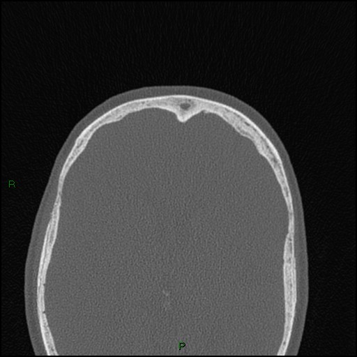 Bilateral frontal mucoceles (Radiopaedia 82352-96454 Axial bone window 62).jpg