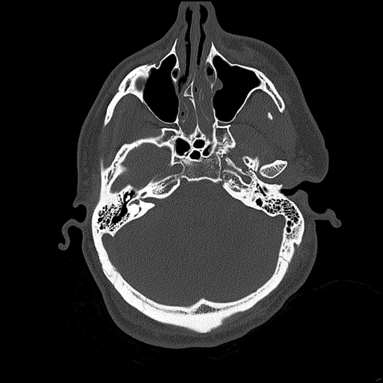 File:Bilateral occipital condyle fracture (type 2) (Radiopaedia 87675-104089 Axial bone thins 61).jpg