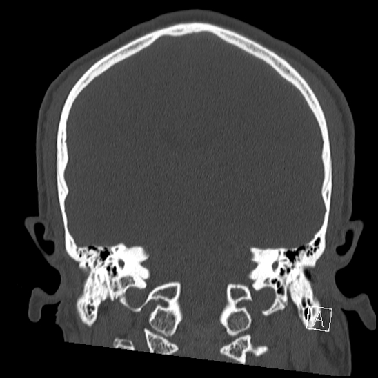 Bilateral occipital condyle fracture (type 2) (Radiopaedia 87675-104089 Coronal bone window 80).jpg