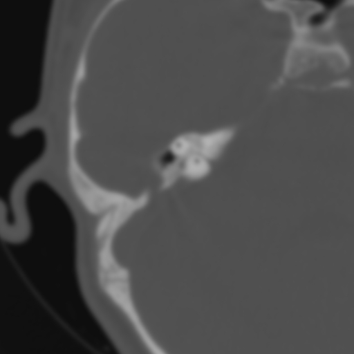 Bilateral otosclerosis (Radiopaedia 57237-64157 B 78).jpg