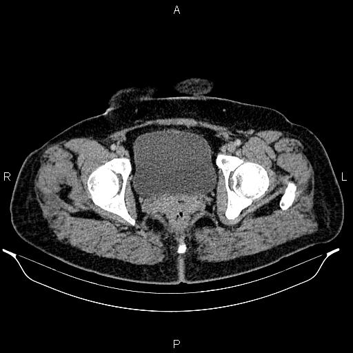 Bilateral ovarian dermoid cysts (Radiopaedia 85785-101603 A 103).jpg