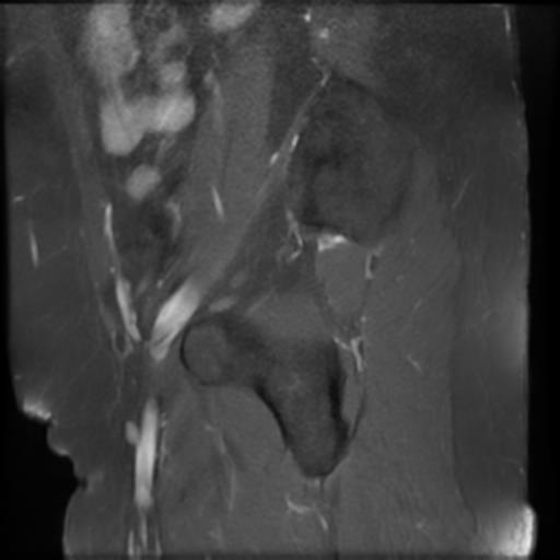 File:Bilateral ovarian dermoid cysts (Radiopaedia 90152-107338 Sagittal T1 C+ 22).jpg