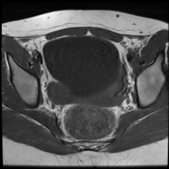 File:Bilateral ovarian fibrothecomas - adolescent (Radiopaedia 86604-102707 Axial T1 18).jpg