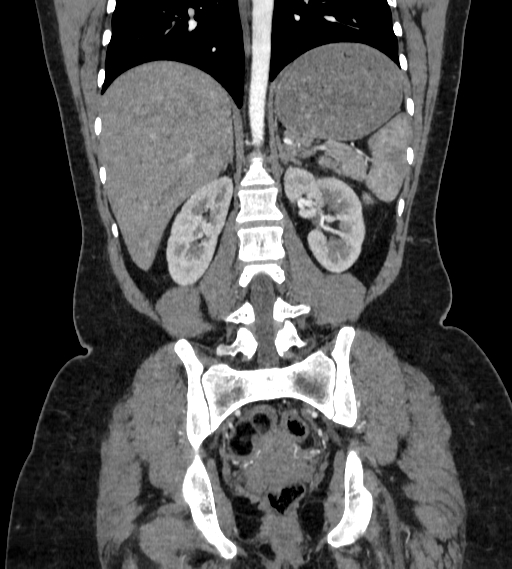 Bilateral ovarian mature cystic teratomas (Radiopaedia 79373-92457 B 60).jpg