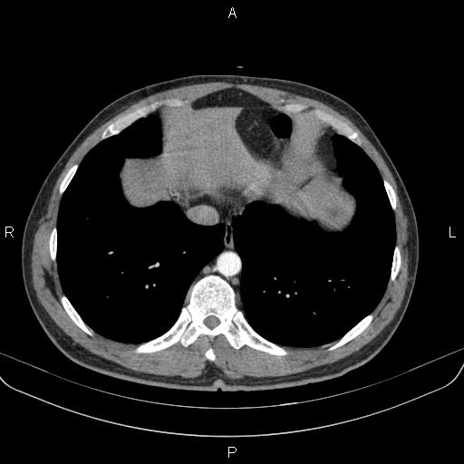 File:Bilateral pulmonary AVM (Radiopaedia 83134-97505 A 57).jpg