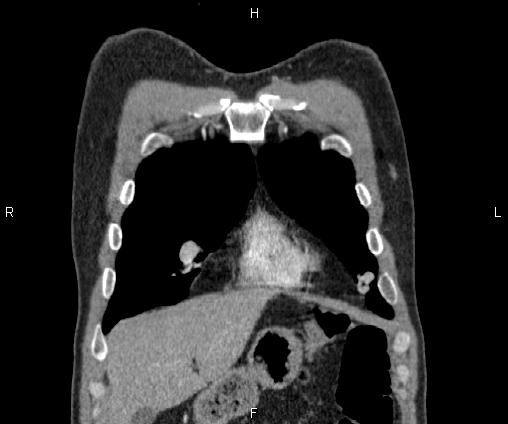 Bilateral pulmonary AVM (Radiopaedia 83134-97505 C 15).jpg