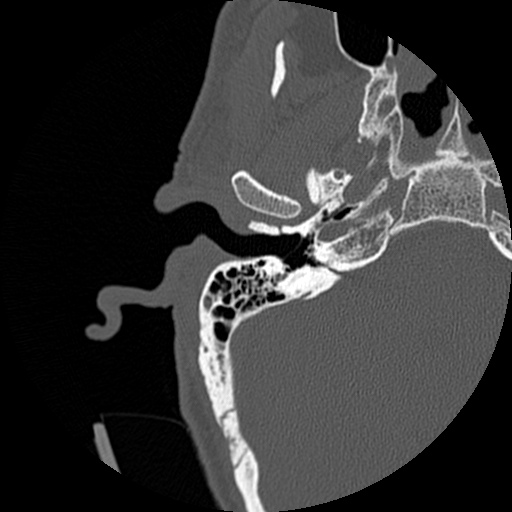 File:Bilateral temporal bone fractures (Radiopaedia 29482-29970 Axial non-contrast 1).jpg