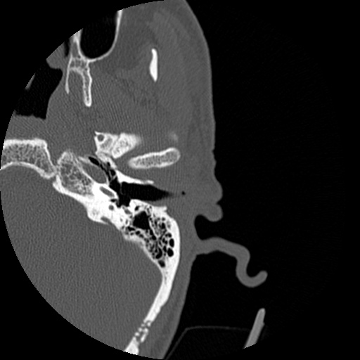 Bilateral temporal bone fractures (Radiopaedia 29482-29970 D 61).jpg