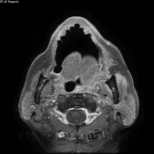 File:Bisphosphonate-related osteonecrosis of the maxilla (Radiopaedia 51367-57101 Axial T1 C+ fat sat 13).jpg