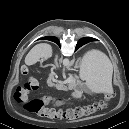 File:Bladder papillary urothelial carcinoma (Radiopaedia 48119-52951 Axial C+ delayed 9).png
