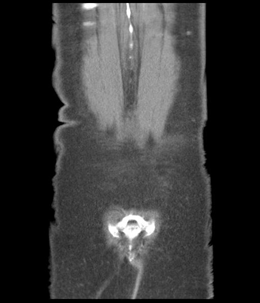 Bladder rupture post renal biopsy (Radiopaedia 30863-31572 Coronal non-contrast 53).jpg