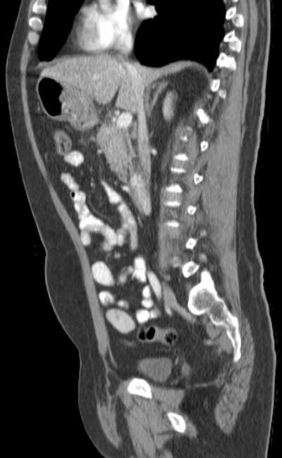 Bleeding duodenal ulcer and adenomyomatosis of gallbladder (Radiopaedia 61834-69861 C 43).jpg