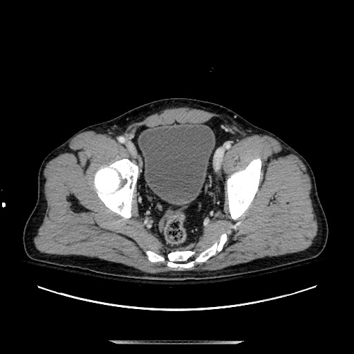 Blunt abdominal trauma with solid organ and musculoskelatal injury with active extravasation (Radiopaedia 68364-77895 A 138).jpg