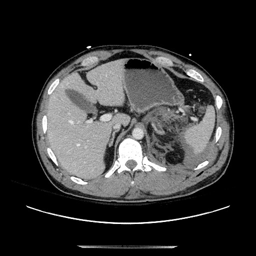 Blunt abdominal trauma with solid organ and musculoskelatal injury with active extravasation (Radiopaedia 68364-77895 A 32).jpg