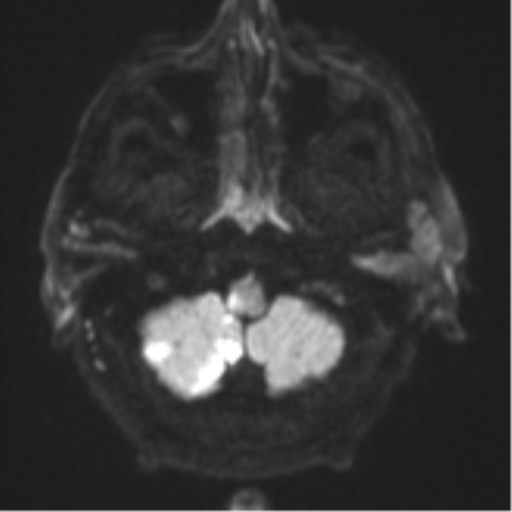 Blunt cerebrovascular injury (Radiopaedia 53682-59745 Axial DWI 35).png
