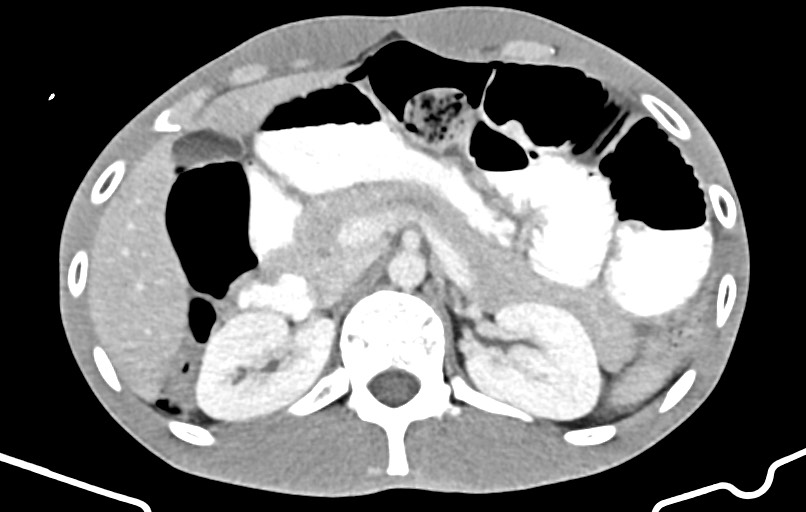 Blunt injury to the small bowel (Radiopaedia 74953-85987 A 46).jpg