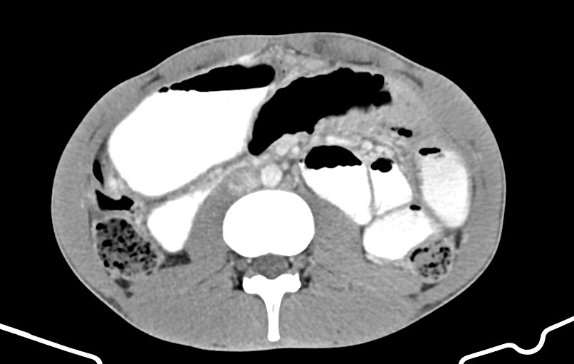 Blunt injury to the small bowel (Radiopaedia 74953-85987 A 86).jpg