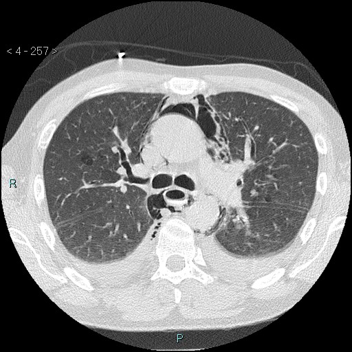 File:Boerhaave syndrome (Radiopaedia 27683-27897 lung window 16).jpg