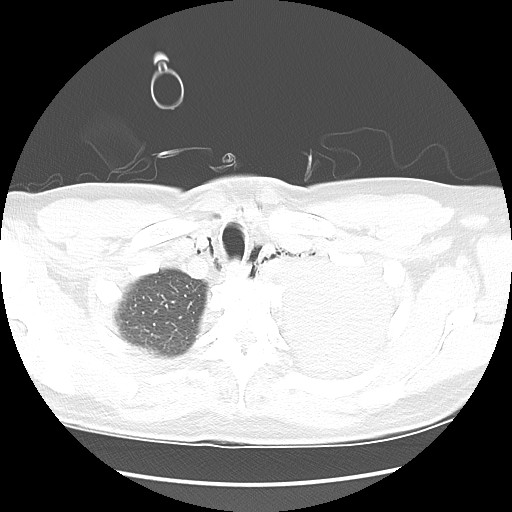 Boerhaave syndrome (Radiopaedia 59796-67310 Axial lung window 12).jpg