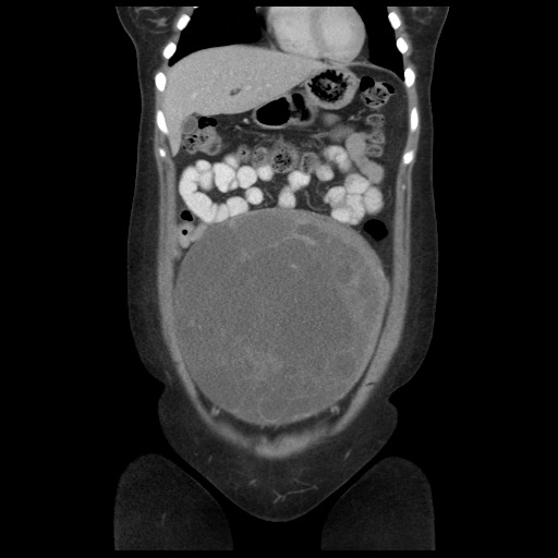 Borderline mucinous tumor (ovary) (Radiopaedia 78228-90808 C 16).jpg