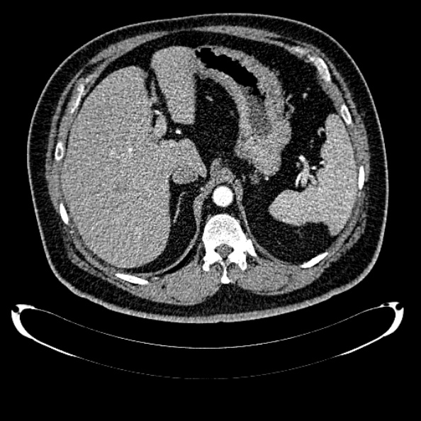 Bosniak renal cyst - type IV (Radiopaedia 24244-24518 B 70).jpg