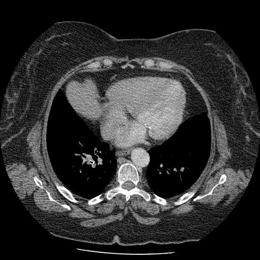 Bovine aortic arch - right internal mammary vein drains into the superior vena cava (Radiopaedia 63296-71875 A 105).jpg
