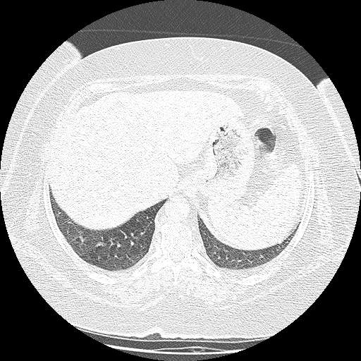 Bovine aortic arch - right internal mammary vein drains into the superior vena cava (Radiopaedia 63296-71875 Axial lung window 153).jpg