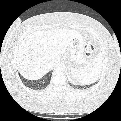 Bovine aortic arch - right internal mammary vein drains into the superior vena cava (Radiopaedia 63296-71875 Axial lung window 163).jpg