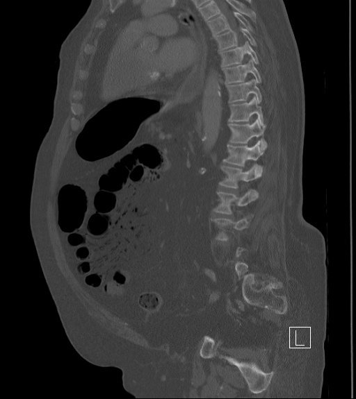 Bowel ischemia secondary to SMA occlusion with extensive portomesenteric venous gas (Radiopaedia 54656-60871 Sagittal bone window 45).jpg
