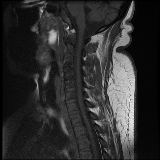 File:Brachial plexopathy (Radiopaedia 21844-21806 Sagittal T1 5).jpg
