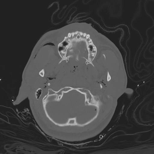 Brain contusions, internal carotid artery dissection and base of skull fracture (Radiopaedia 34089-35339 Axial bone window 42).png
