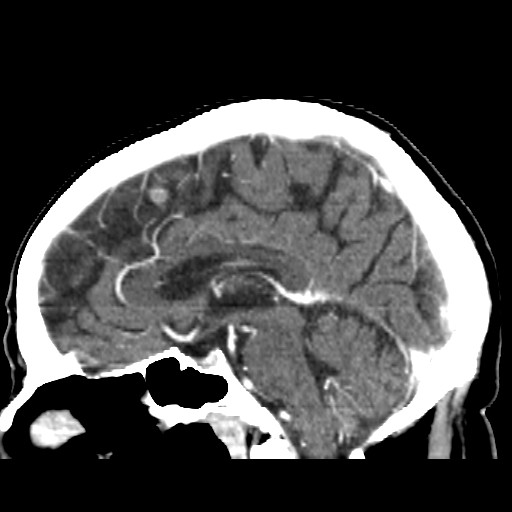 Brain metastasis (Radiopaedia 42617-45760 D 28).jpg