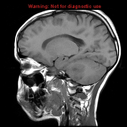 File:Brainstem glioma (Radiopaedia 9444-10124 Sagittal T1 8).jpg
