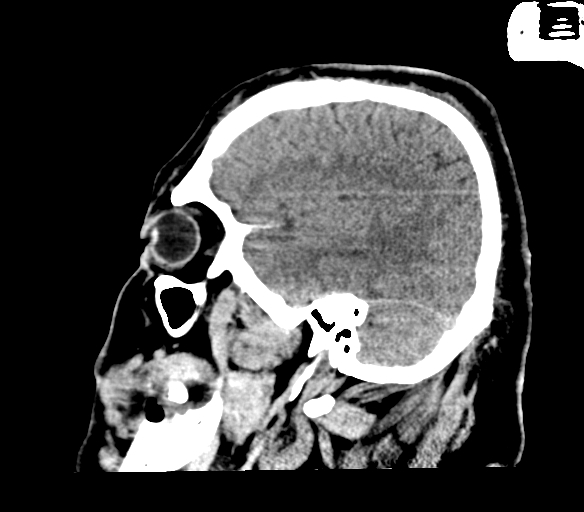Brainstem hemorrhage (Radiopaedia 81294-94976 C 13).jpg