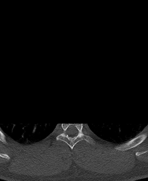 Branchial cleft cyst (Radiopaedia 31167-31875 Axial bone window 92).jpg