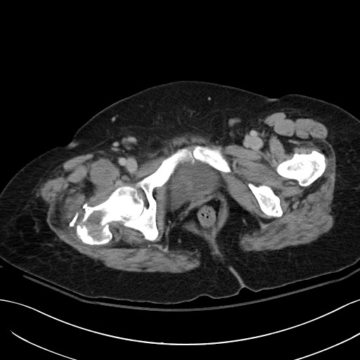 File:Breast carcinoma with pathological hip fracture (Radiopaedia 60314-67974 B 72).jpg
