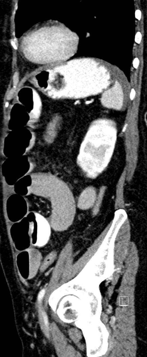 Broad ligament hernia (Radiopaedia 84802-100276 C 17).jpg