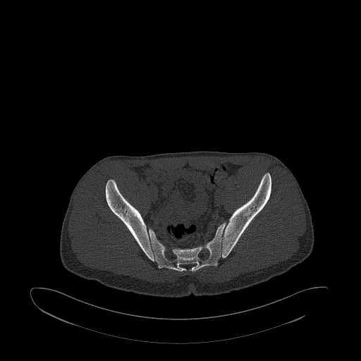 Brodie abscess- femoral neck (Radiopaedia 53862-59966 Axial bone window 81).jpg