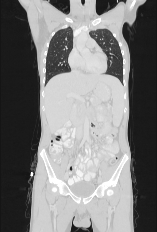 Bronchial carcinoid tumor (Radiopaedia 57187-64090 Coronal lung window 35).jpg