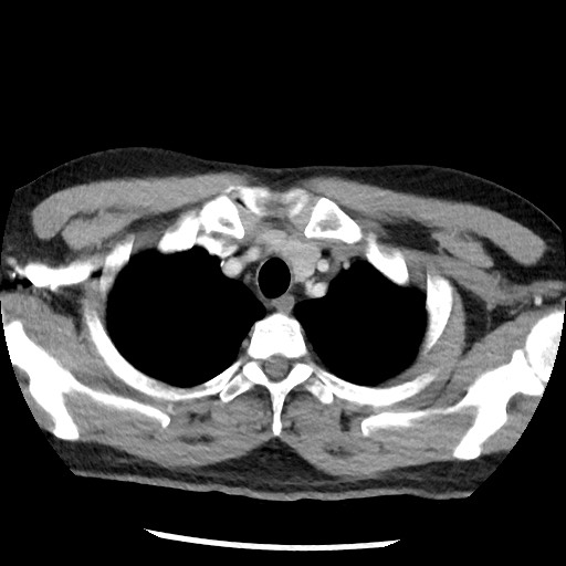 Bronchial carcinoid tumor (Radiopaedia 67377-76764 A 12).jpg