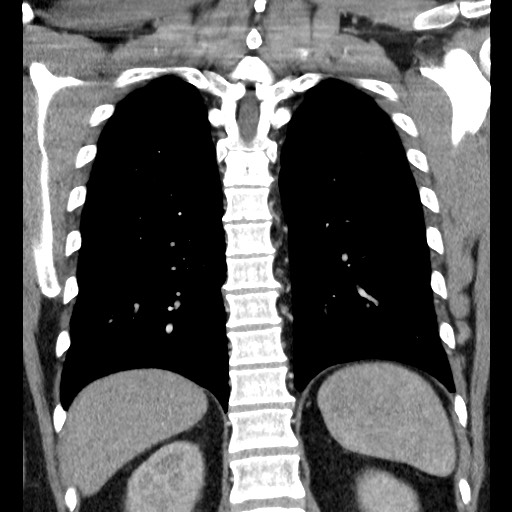 Bronchial carcinoid tumor (Radiopaedia 67377-76764 C 48).jpg