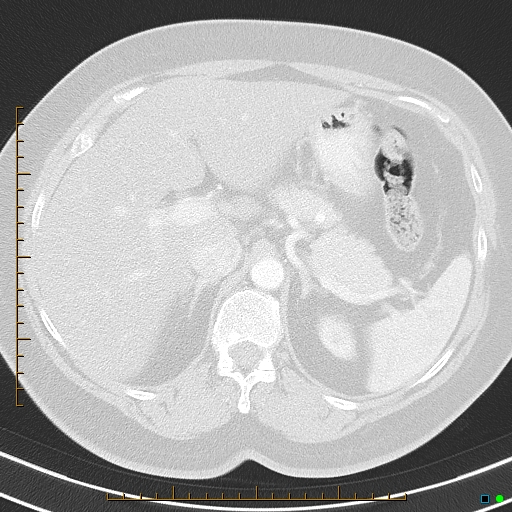 Bronchial diverticula (Radiopaedia 79512-92675 Axial lung window 51).jpg