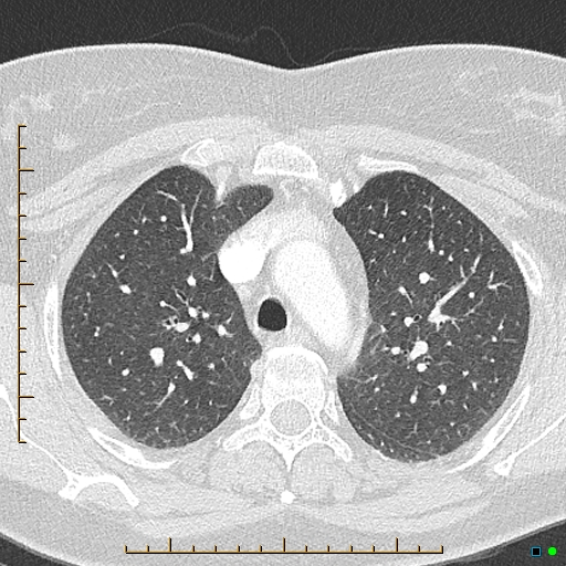 Bronchial diverticula (Radiopaedia 79512-92676 Axial lung window 47).jpg