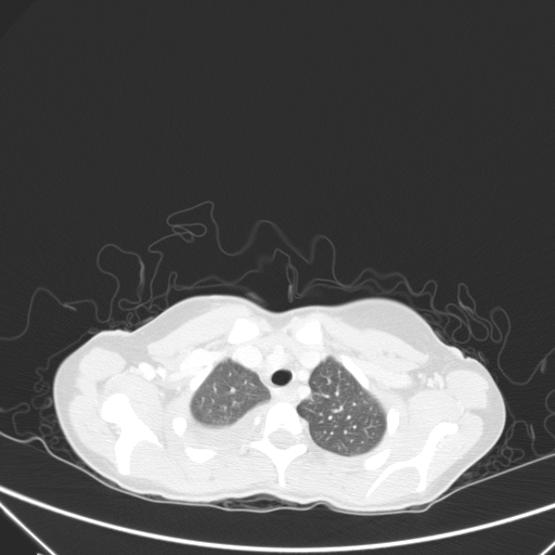 Bronchial mucoepidermoid carcinoma (Radiopaedia 57023-63895 Axial lung window 13).jpg