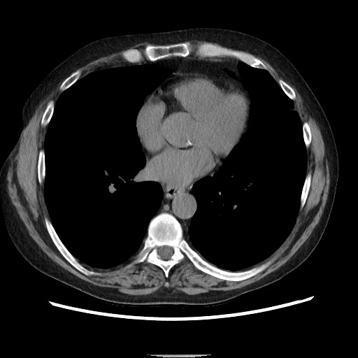 Bronchial stenosis - lung transplant (Radiopaedia 73133-83848 Axial non-contrast 39).jpg