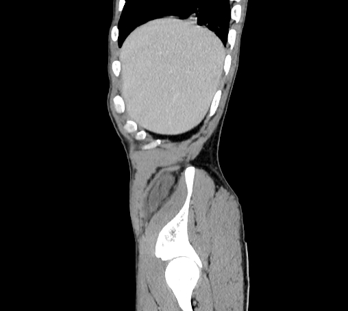 File:Bronchiectasis in Crohn disease (Radiopaedia 60311-67977 D 10).jpg