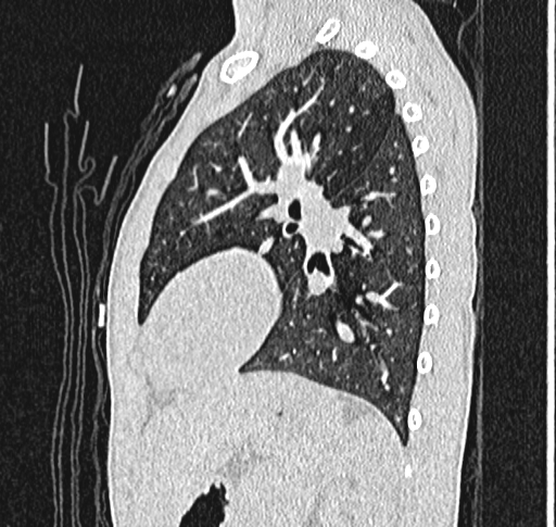 Bronchiolitis obliterans (Radiopaedia 71538-81897 Sagittal lung window 47).jpg