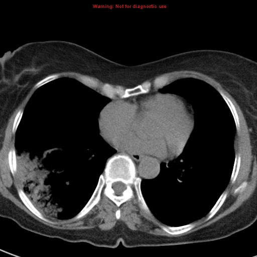 File:Bronchoalveolar carcinoma (BAC) (Radiopaedia 13436-13392 Axial non-contrast 33).jpg
